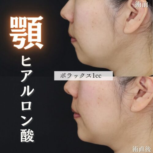 あご　ヒアルロン酸　症例